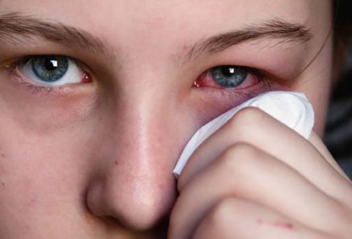 La conjuntivitis es una inflamación de la cubierta delgada transparente de la parte blanca del ojo y del interior de los párpados.