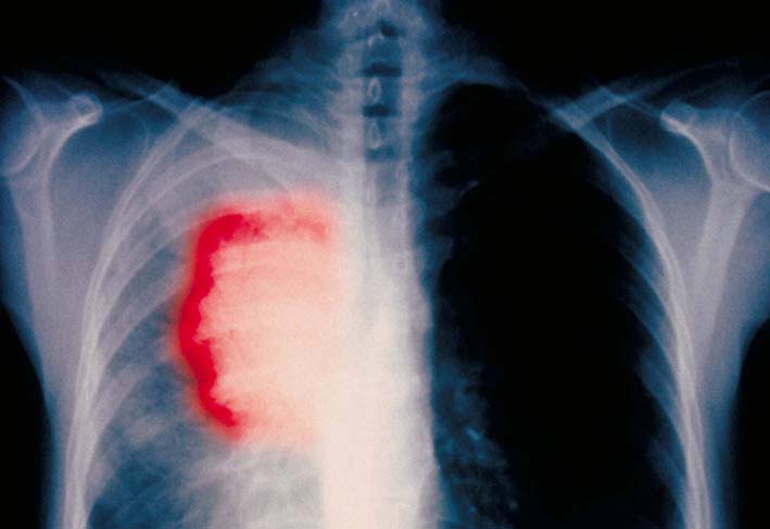 El cáncer de pulmón es una enfermedad muy agresiva.