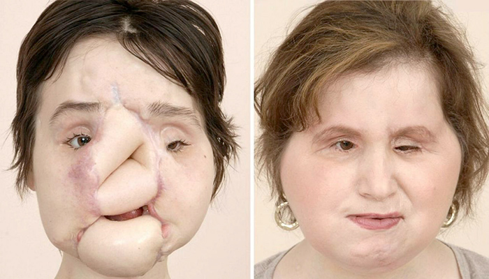 El rostro antes y despúes del trasplante de Katie Stubblefield.