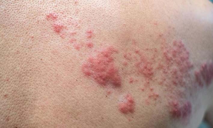 Herpes zóster, infección viral que produce una erupción dolorosa.