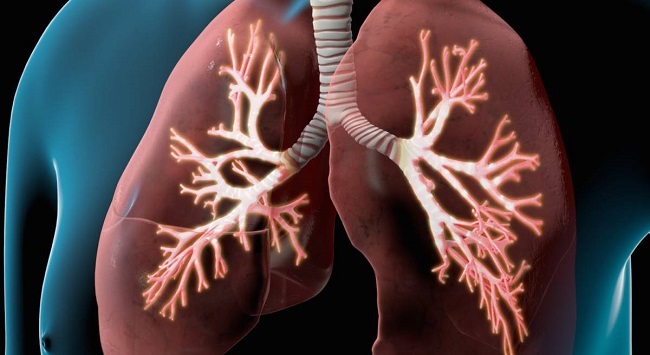 EPOC son un Conjunto de enfermedades pulmonares que obstruyen la circulación de aire y dificultan la respiración.