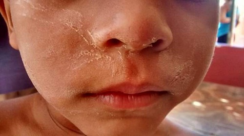 Niños presentan erupciones en la piel, en las extremidades del cuerpo.
