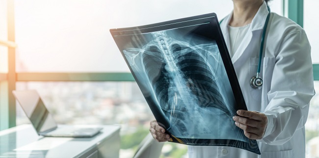 El diagnóstico de esta patología requiere una precisa historia clínica y examen físico como laboratorios y radiografía de tórax