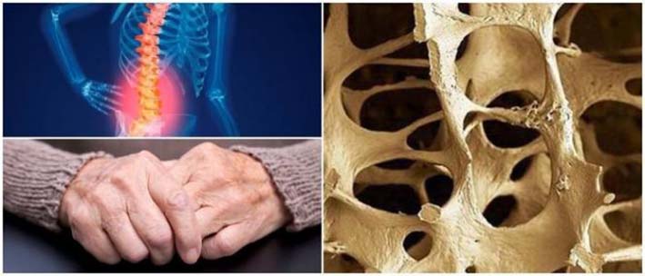 1 de cada 2 mujeres se fractura un hueso debido a la osteoporosis 