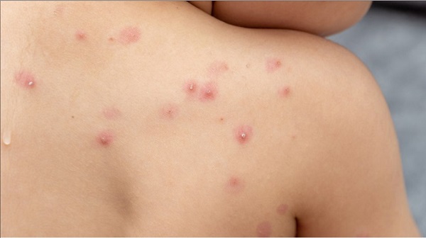El término ‘mpox’ es una abreviación de ‘monkeypox’, ‘viruela del mono’ en inglés’, y será incluido en la lista oficial de enfermedades que la OMS actualizará en 2023.