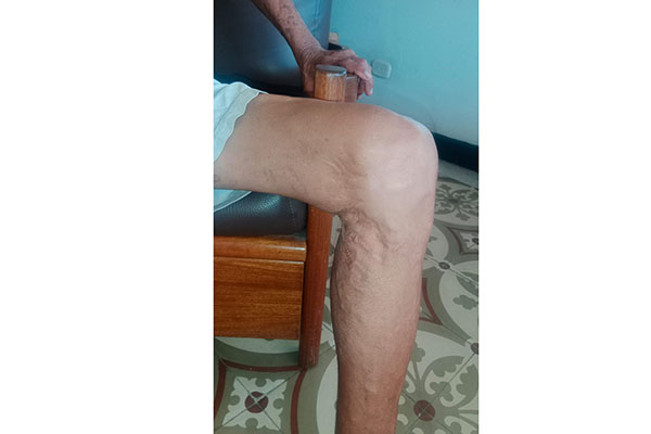 La fotografía muestra las cicatrices en su pierna izquierda como evidencias por el ataque del tiburón.