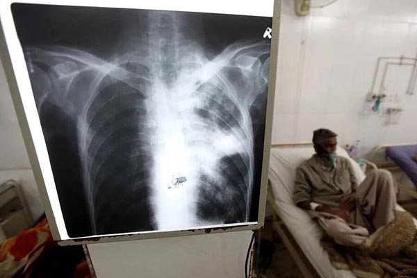 Imagen de referencia de una radiografía de unos pulmones infectados con tuberculosis. Foto EFE
