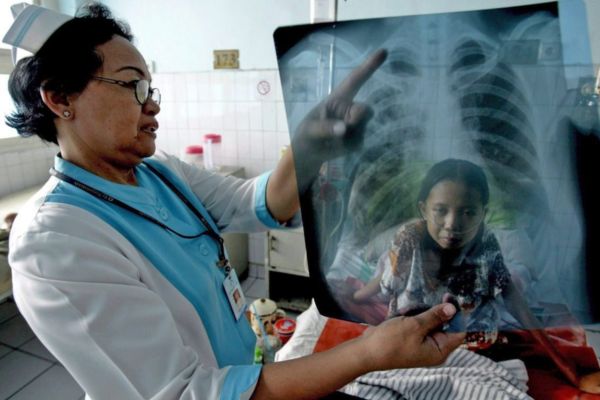 Una enfermera indonesia muestra una radiografía a Arni, que está recibiendo tratamiento médico contra la tuberculosis en un hospital de Yakarta, Indonesia. Archivo EFE/Bagus Indahono
