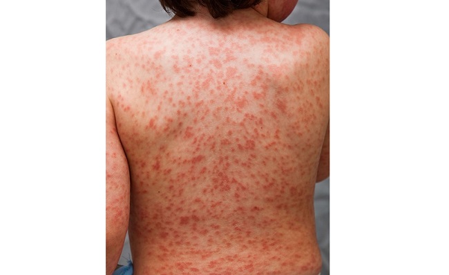 Las erupciones rojas en la piel es uno de los síntomas característicos.