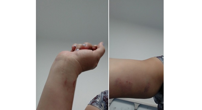 Imagen de los golpes que recibió la mujer denunciante en Santa Marta.