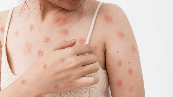 Las complicaciones de la viruela símica pueden ser infecciones secundarias, bronconeumonía, septicemia, encefalitis e infección de la córnea con la consiguiente pérdida de la visión.  