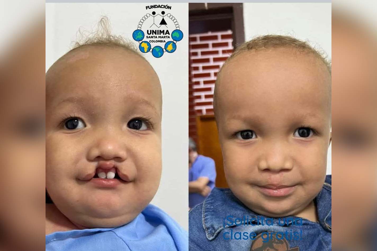 Las jornadas de Unima han transformado la vida de decenas de niños con labio y paladar fisurado en Santa Marta.Foto cortesía Fundación Unima