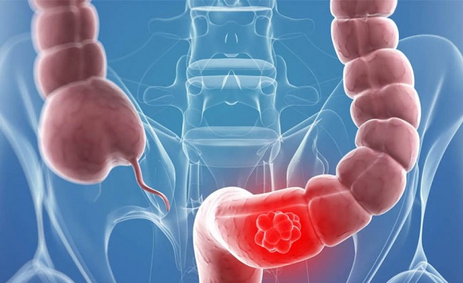 Las personas mayores de 50 años corren mayor riesgo de padecer cáncer de colon.
