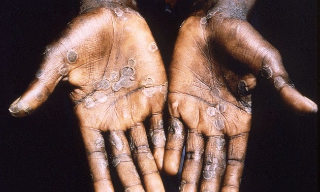 La enfermedad se llama viruela del simio porque se identificó por primera vez en colonias de monos para investigación en 1958. Solo se detectó más tarde en humanos en 1970.