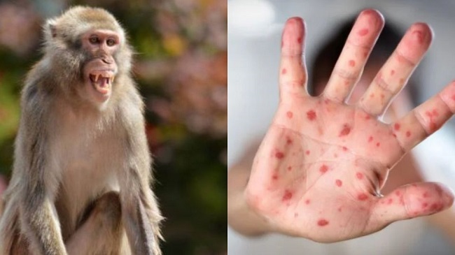 La viruela del simio es menos contagiosa que la viruela y causa una enfermedad menos grave.