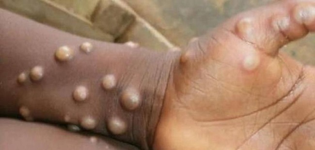 La viruela del mono generalmente se presenta clínicamente con fiebre, sarpullido e inflamación de los ganglios linfáticos y puede provocar una variedad de complicaciones médicas.