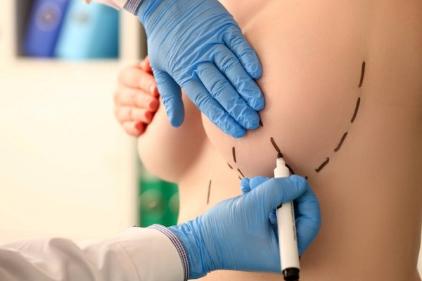 La Mastopexia, es un procedimiento estético también conocida como levantamiento de senos.