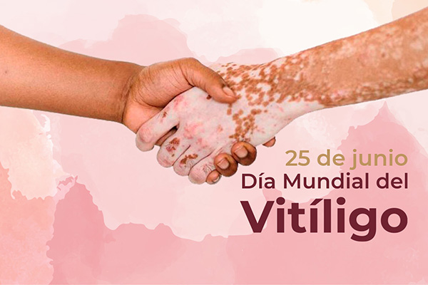 El vitíligo es un padecimiento autoinmune y progresivo.
